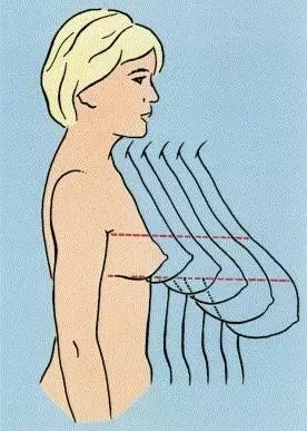 巨乳症不同程度示意图 巨乳症不同程度示意图