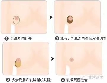 胸部缩小乳晕周围切开法手术示意图 胸部缩小乳晕周围切开法手术示意图
