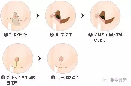 胸部缩小倒T字切开法手术示意图 胸部缩小倒T字切开法手术示意图