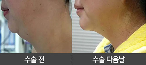 韩国永整形医院双下巴溶脂提术照片