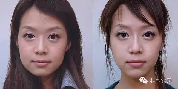 面部吸脂和瘦脸针哪个瘦脸效果好?