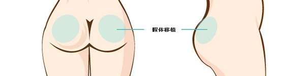 将臀骨之间作隐蔽纵形切口,在肌肉层之间植入柔软的假体,将没弹力的