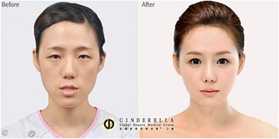 韩国新帝瑞娜整形外科颧骨整形案例