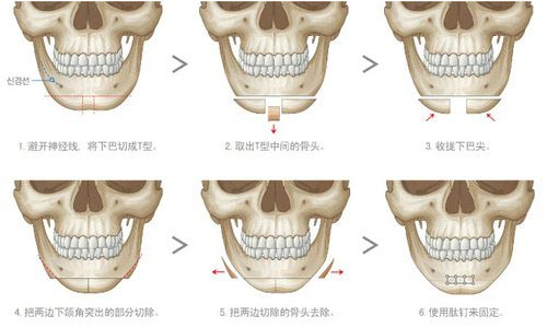 下颌角手术过程