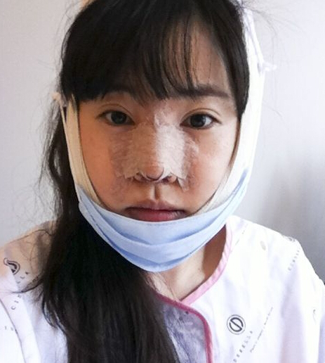 韩国新帝瑞娜面部轮廓后第一天的照片