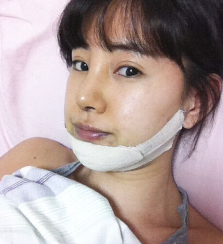 韩国新帝瑞娜面部轮廓后第5天的照片