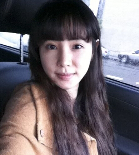 韩国新帝瑞娜面部轮廓术后两周的照片