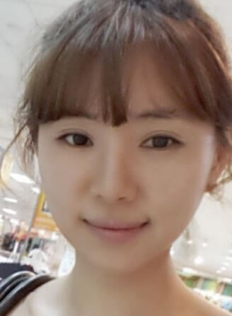 韩国新帝瑞娜面部轮廓后的照片