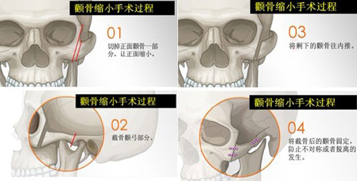 韩国颧骨整形手术过程