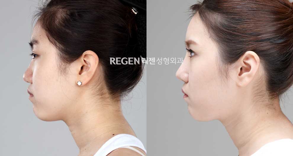 鼻综合手术对比图(图片来源于韩国丽珍整形医院)