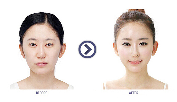 V型脸手术前后对比案例