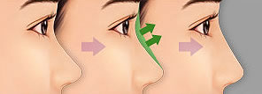 短鼻整形手术方法介绍
