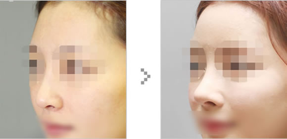 韩国topclass整形医院鼻整形真实对比案例图