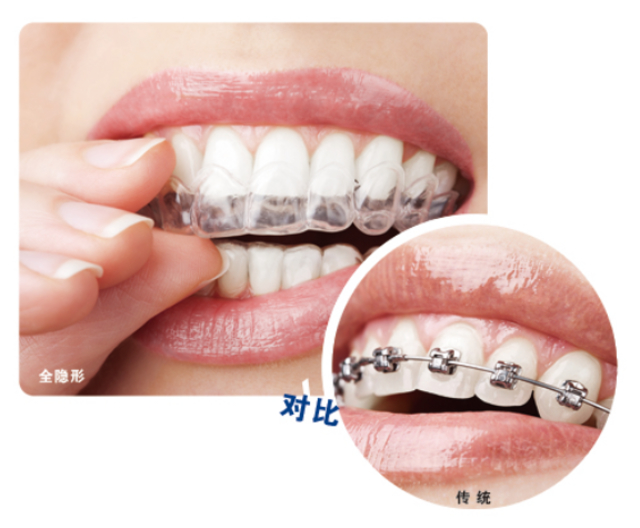 隐形牙齿矫正和传统牙齿矫正对比