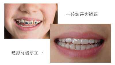 传统牙齿矫正与隐形牙齿矫正美观度对比