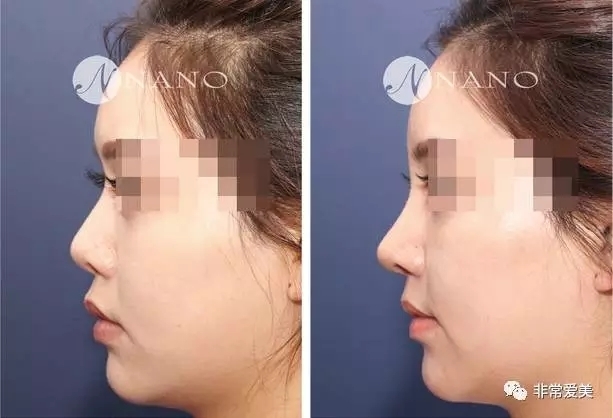 韩国Nano整形外科自体软骨隆鼻