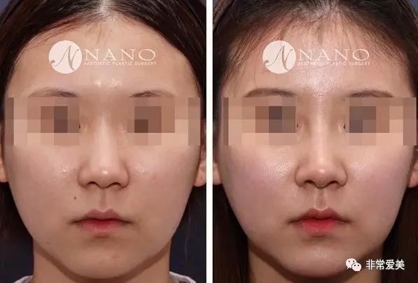 韩国Nano整形外科隆鼻正面对比图