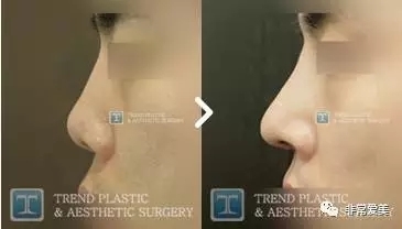 韩国Trend整形外科男式隆鼻对比