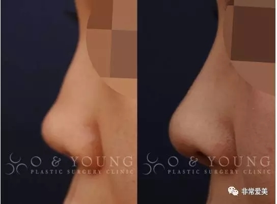 韩国O&YOUNG整形外科隆鼻对比