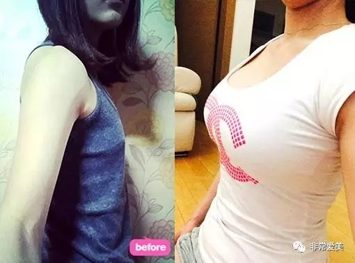 韩国硅胶假体隆胸对比