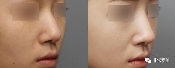 隆鼻手术后，求美者的鼻部案例对比