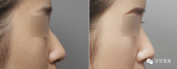 假体隆鼻手术案例对比