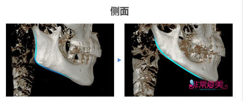 韩国TL整形医院面部轮廓CT图侧面