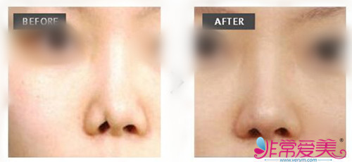 小婕在韩国Will医院做鼻部修复后的效果对比图