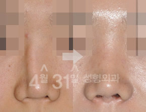韩国4月31日整形外科鼻修复