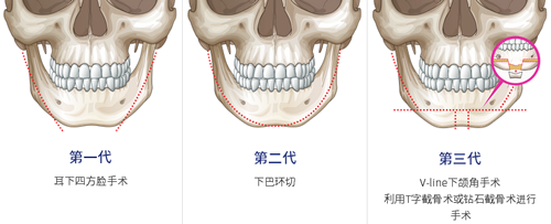 不同下颌骨手术方法示意图
