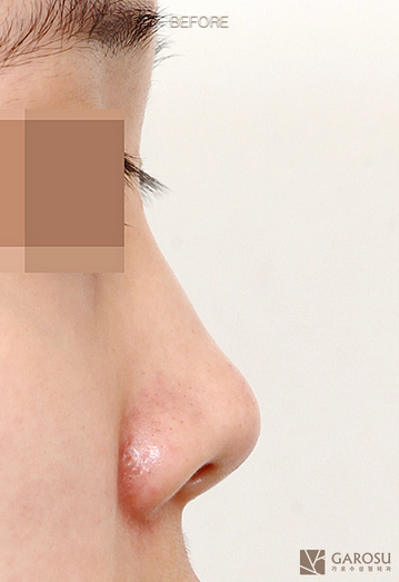 隆鼻术前鼻部缺点有哪些