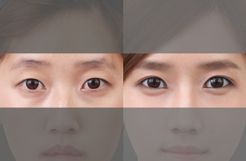 韩国原辰医院双眼皮手术对比