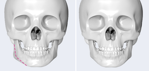 长曲线下颌骨手术示意图