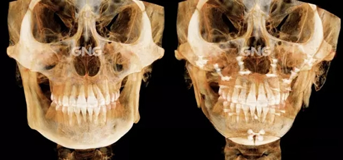 面部轮廓整形术后CT照片