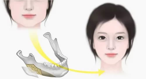 韩国做下颌骨手术特点