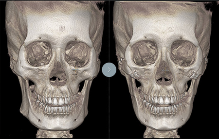 DA医院下颌角截骨CT拍摄图
