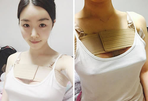 韩国ID医院做假体隆胸术后
