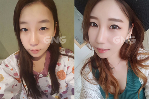 韩国GNG整形外科双眼皮手术对比