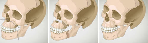 双鄂手术对骨骼影响有哪些