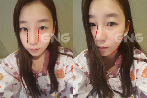 韩国GNG医院做双眼皮手术特点有哪些