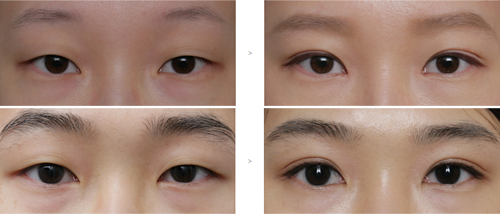 韩国麦恩整形外科双眼皮对比