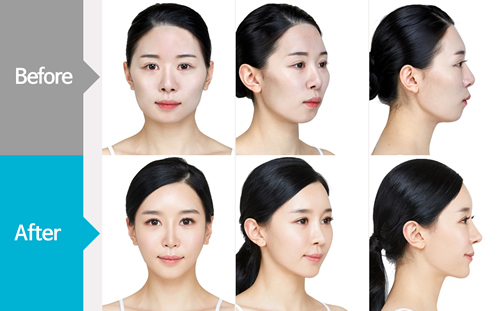 韩国爱琳做面部轮廓案例对比