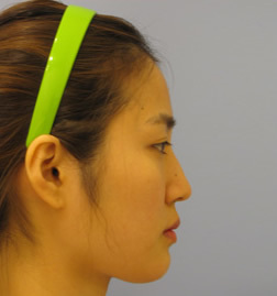 韩国美自人医院隆鼻术前照片展示