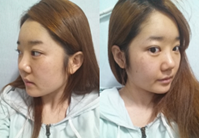 韩国ID整形外科V-line整形术前照片