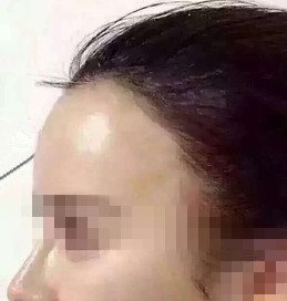 额头脂肪填充过多
