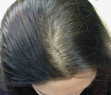 植发手术能治疗脱发吗