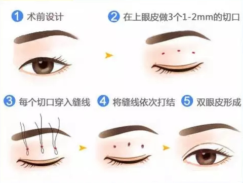 三点定位双眼皮手术方法