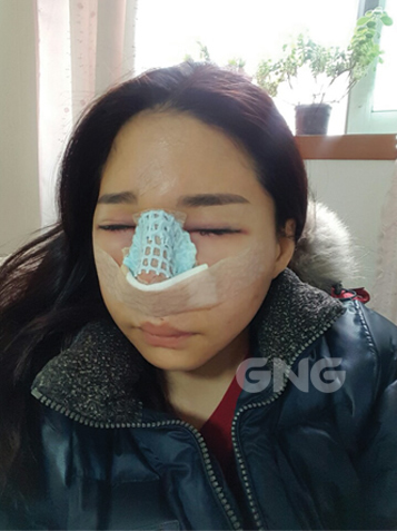 在GNG医院做了假体隆鼻手术