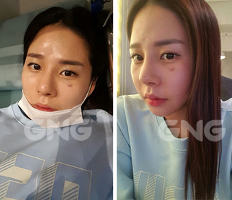 韩国假体隆鼻术后一周恢复