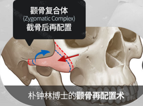 韩国巴诺巴奇整形医院面部轮廓首席院长朴钟林博士颧骨再配置手术原理